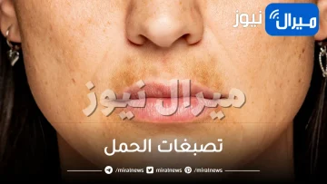 تصبغات الحمل وعلاجها