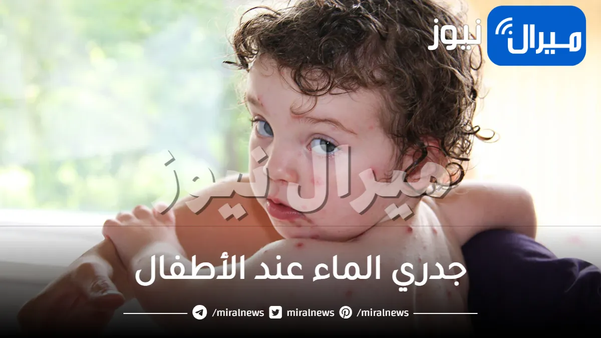 جدري الماء عند الأطفال .. أسبابة وطرق علاجه في المنزل