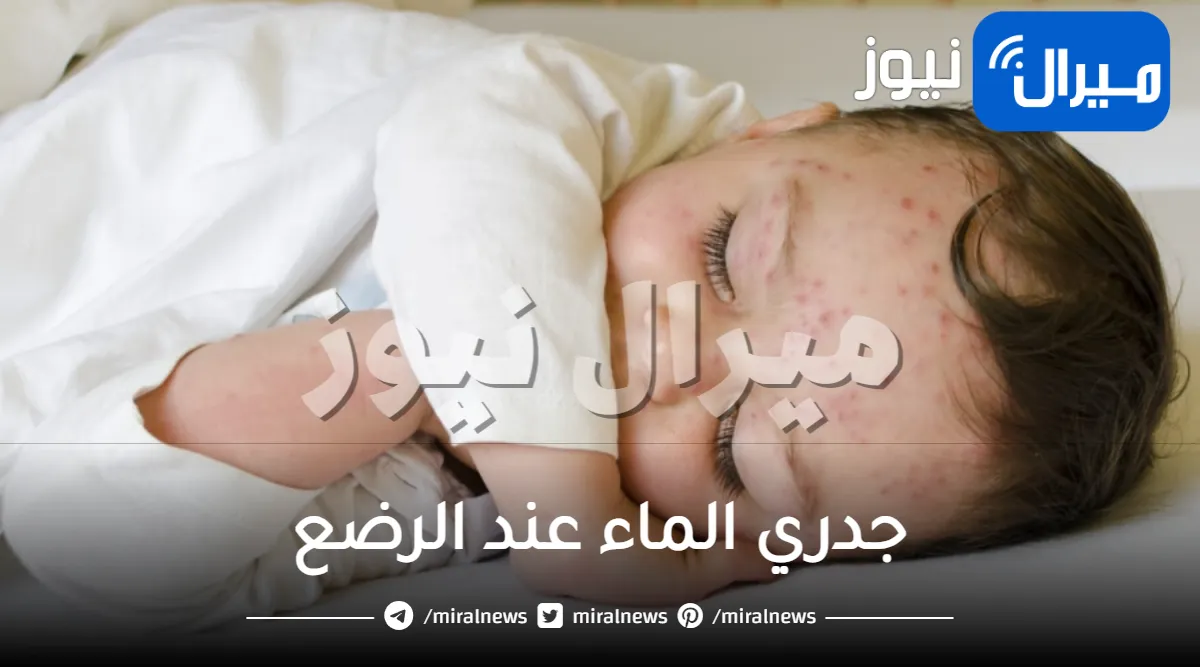 جدري الماء عند الرضع .. تعرفي على العلاج والوقاية