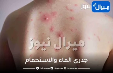جدري الماء والاستحمام .. نصائح للتعامل مع هذا المرض