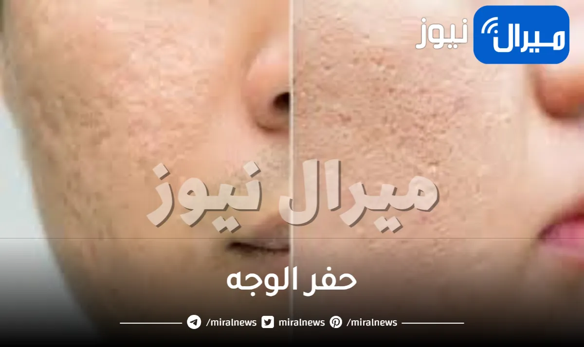 حفر الوجه .. تعرفي على الأسباب وطرق العلاج الممكنة