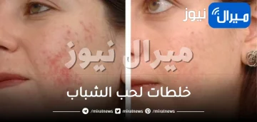 خلطات لحب الشباب .. أبرز ماسكات لعلاج حب الشباب في فترة قصيرة