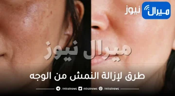 6 طرق لإزالة النمش من الوجه نهائيًا