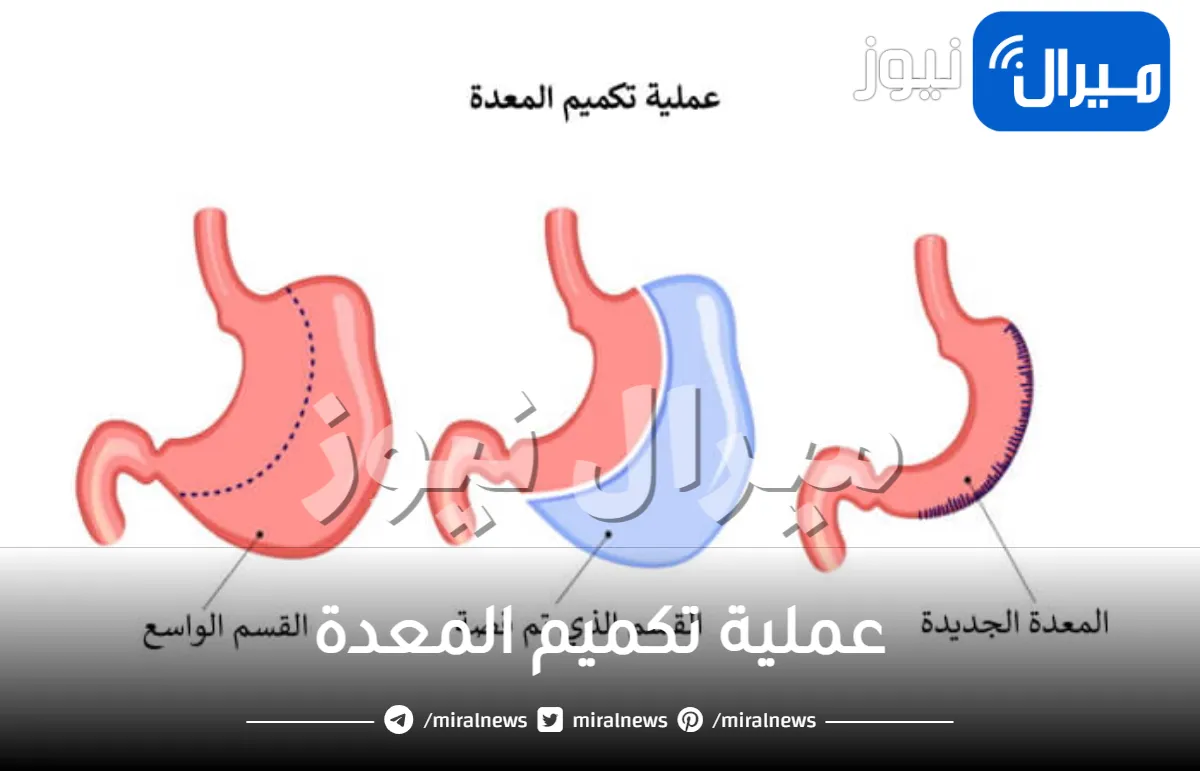 عملية تكميم المعدة أسرع انقاص الوزن