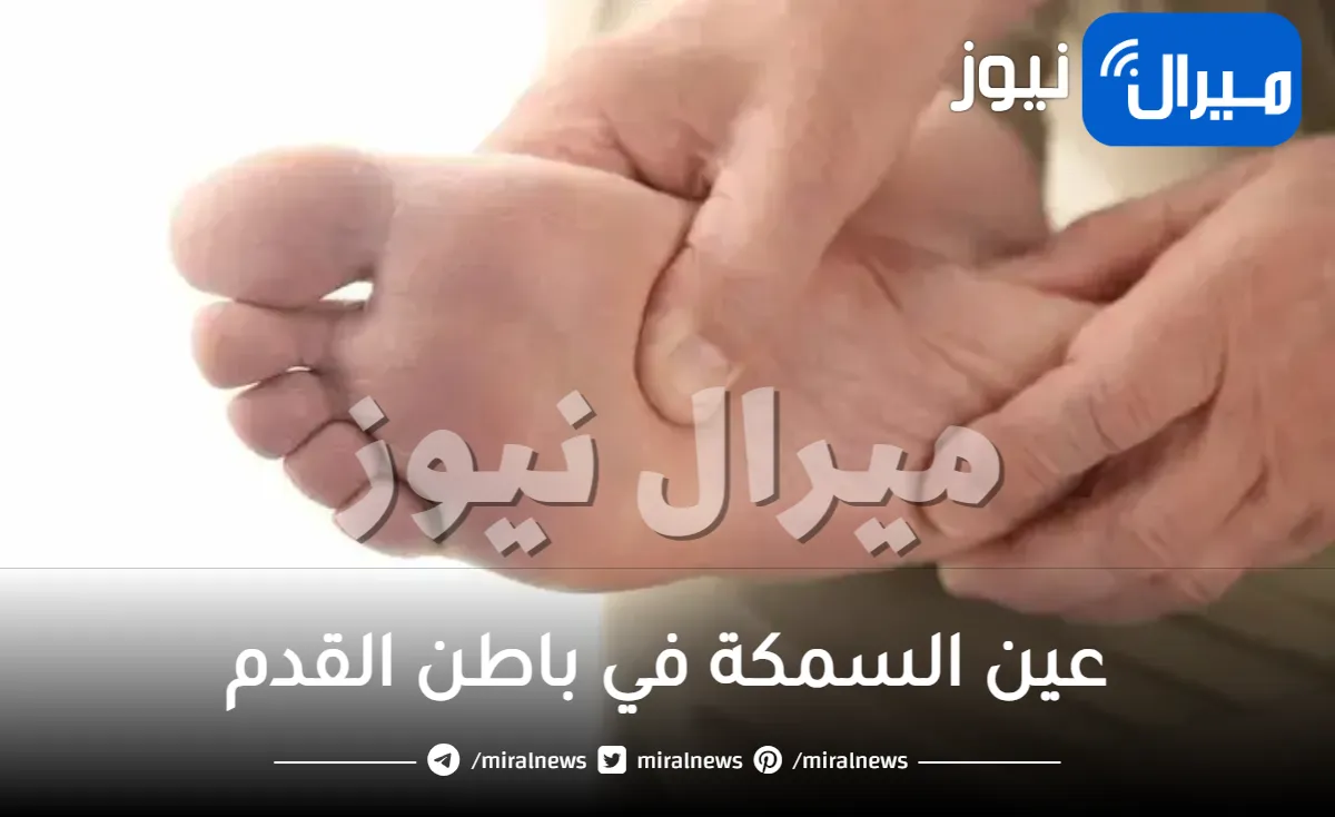 عين السمكة في باطن القدم .. اسبابها وطرق علاجها طبيا وطبيعيا