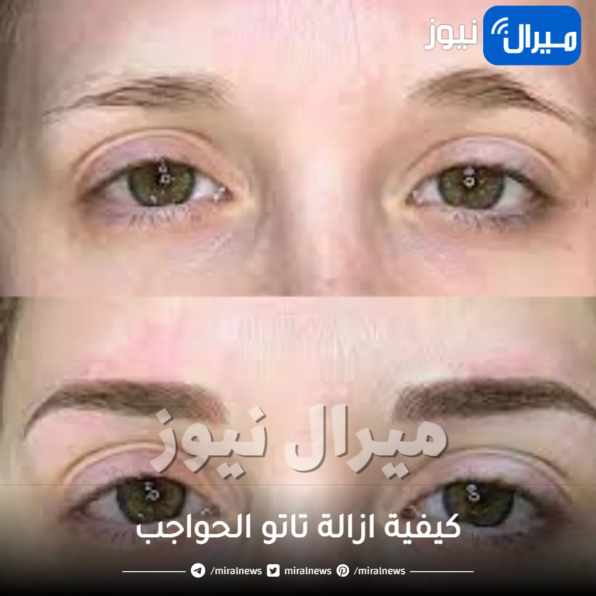كيفية ازالة تاتو الحواجب