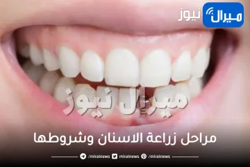 مراحل زراعة الاسنان وشروطها