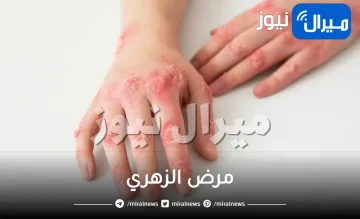 مرض الزهري .. أسبابه وطرق الوقاية منه