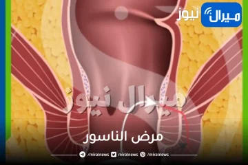 ما هو مرض الناسور وماهي انواعه وكيفية علاجه؟