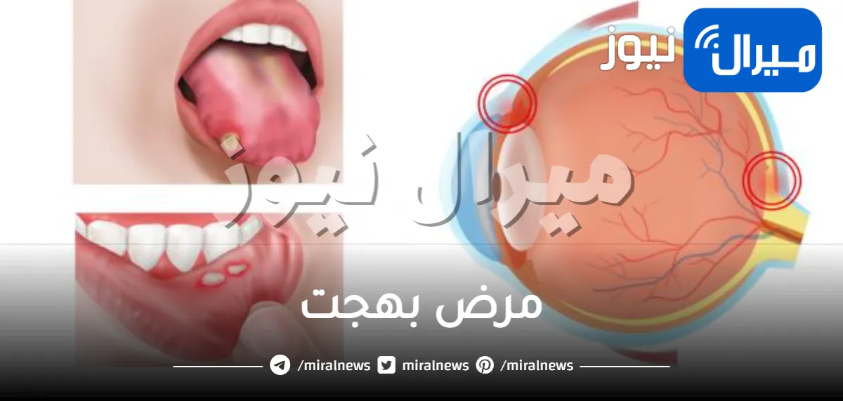 مرض بهجت .. ما سر غموضه وسبب تسميته بهذا الاسم؟