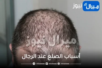 أسباب الصلع عند الرجال وطرق علاجه المختلفة