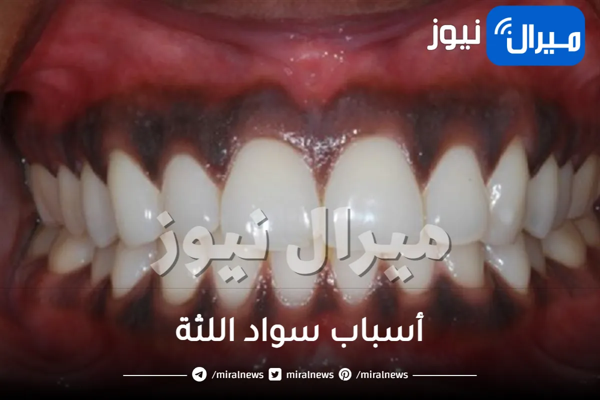 أسباب سواد اللثة وكيفية علاجها بطرق طبيعية 100%