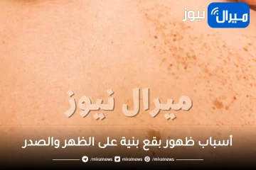 أسباب ظهور بقع بنية على الظهر والصدر