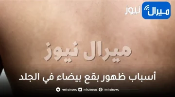 ما هي أسباب ظهور بقع بيضاء في الجلد