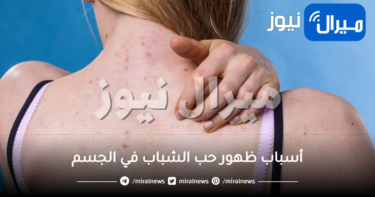 8 مسببات لحب الشباب في الجسم وماذا تفعلي حيال ذلك