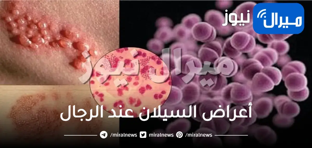 أعراض السيلان عند الرجال