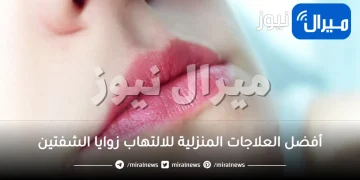 14 علاج منزلي لالتهاب زوايا الشفاه