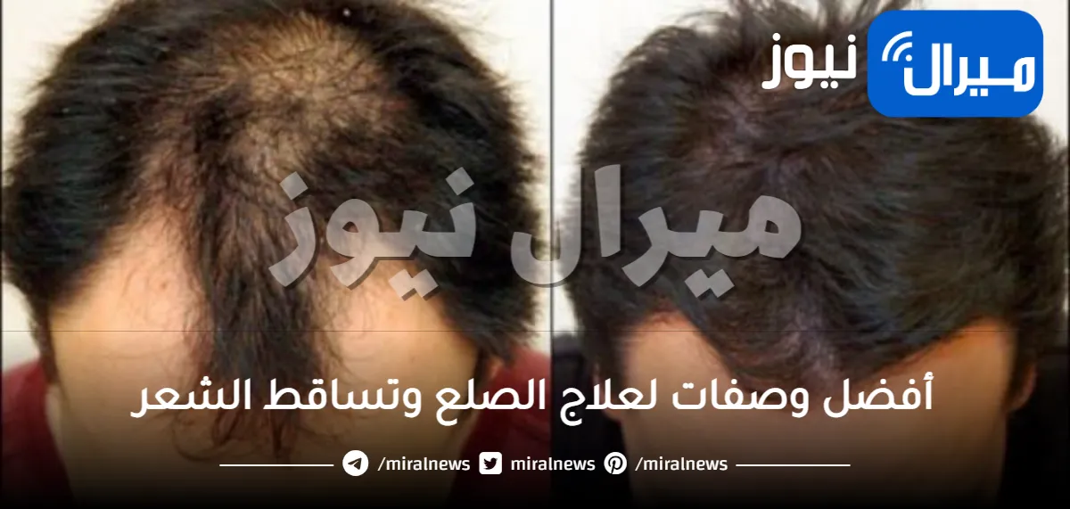 11 وصفة طبيعية لعلاج الصلع في المنزل