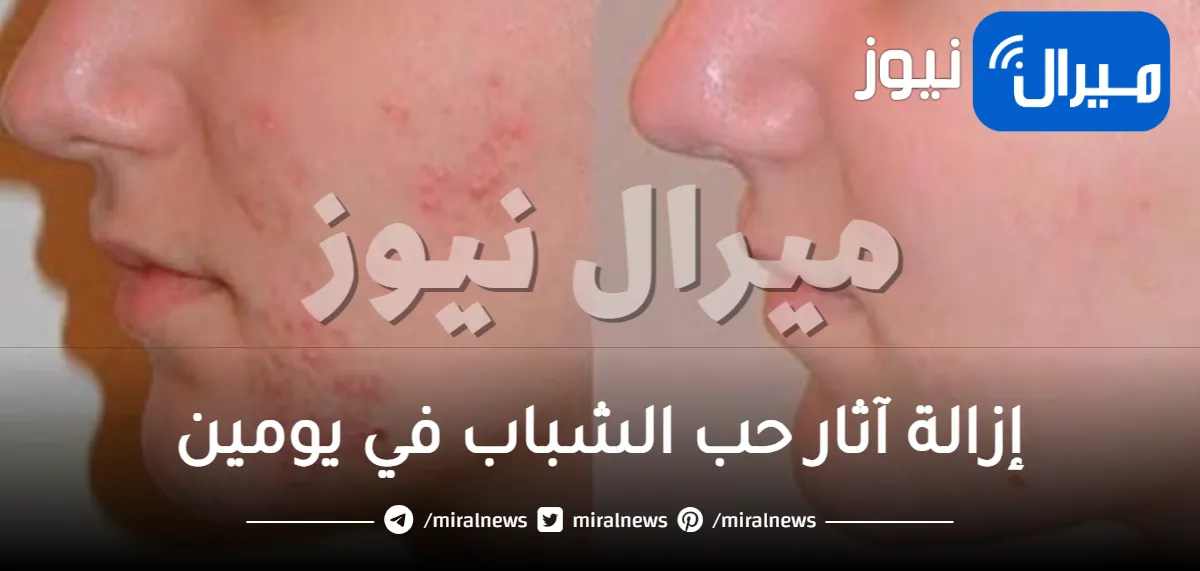 إزالة آثار حب الشباب في يومين