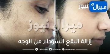إزالة البقع السوداء من الوجه