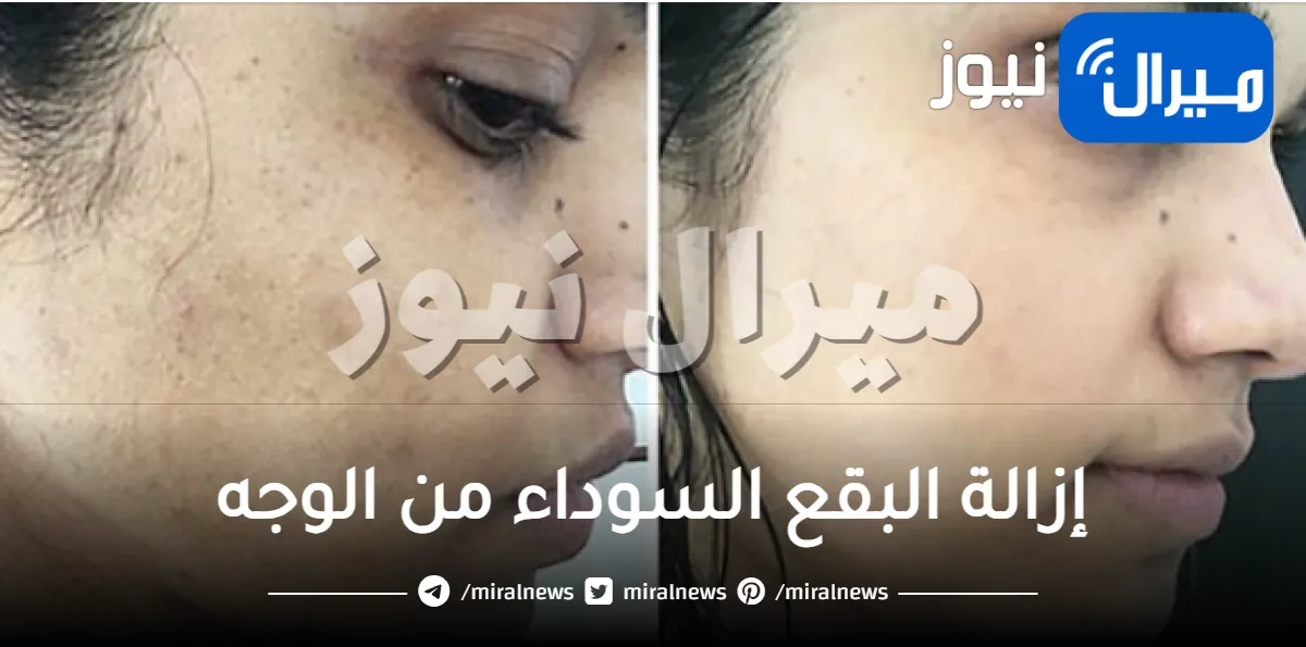 إزالة البقع السوداء من الوجه