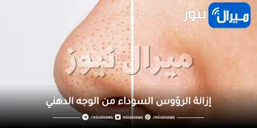 إزالة الرؤوس السوداء من الوجه الدهني