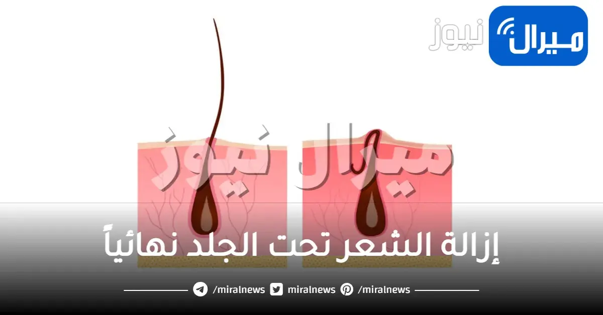 إزالة الشعر تحت الجلد نهائياً تجربتي