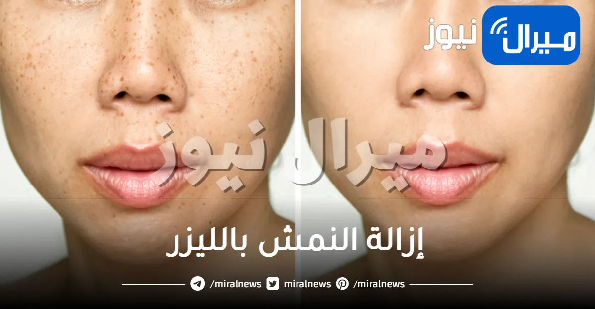 إزالة النمش بالليزر
