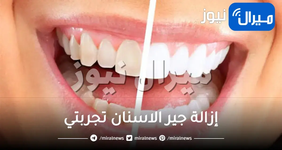 إزالة جير الاسنان تجربتي لتنظيف الاسنان في المنزل