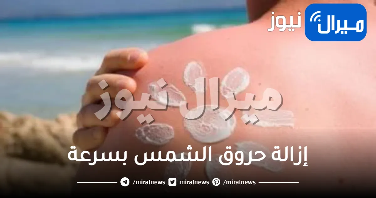 إزالة حروق الشمس بسرعة عبر وصفات فعالة بمكونات بسيطة