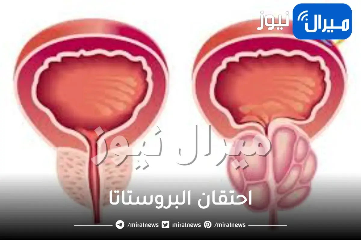 احتقان البروستاتا