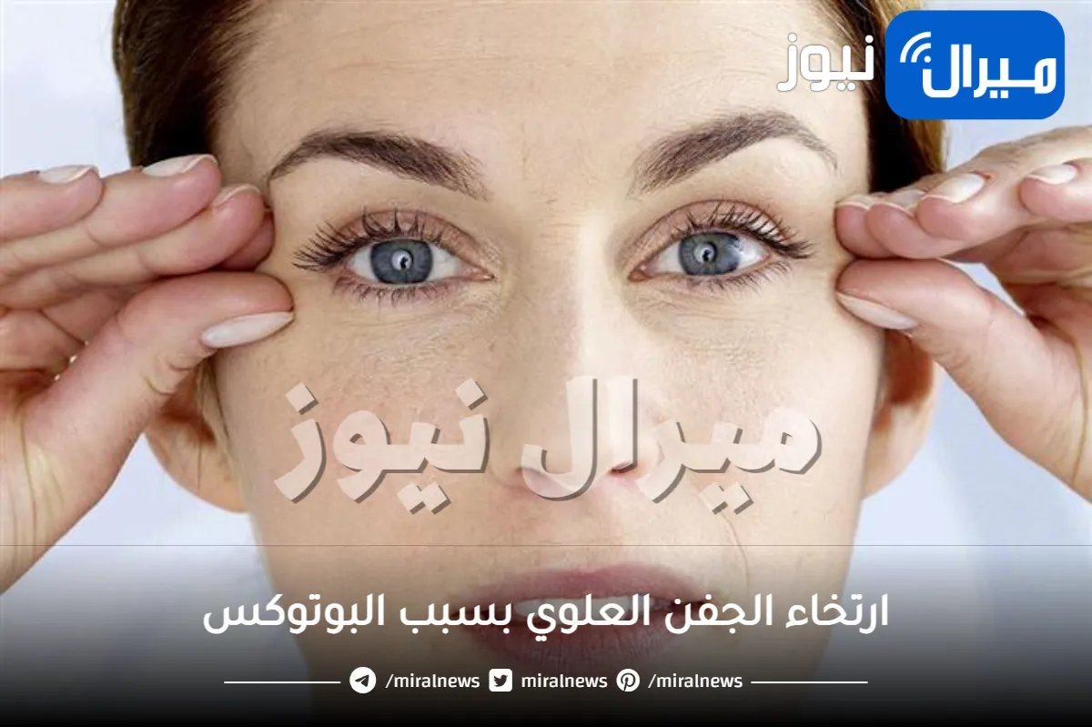 ارتخاء الجفن العلوي بسبب البوتوكس