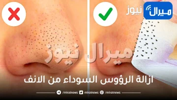 20 طريقة لازالة الرؤوس السوداء من الانف بالليمون
