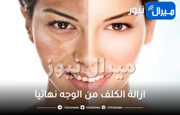 ازالة الكلف من الوجه نهائيا
