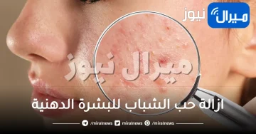 طريقة ازالة حب الشباب للبشرة الدهنية