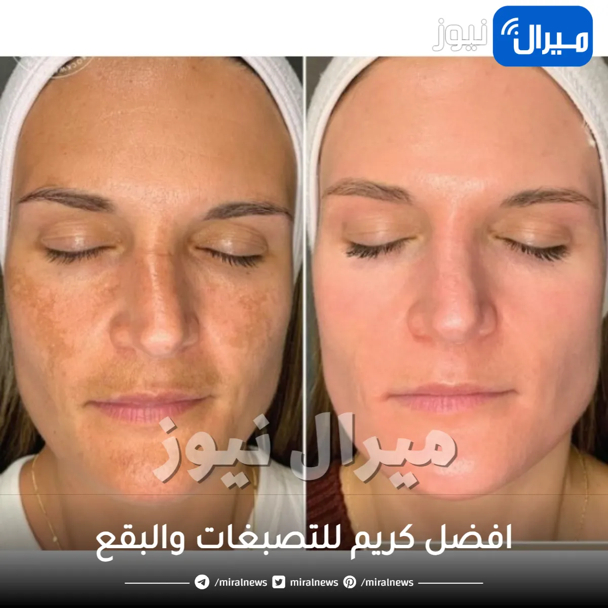 افضل كريم للتصبغات والبقع من الوجه والجسم نهائيا