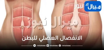 الانفصال العضلي للبطن