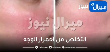 احمرار الوجه..أسبابه وأفضل الماسكات للتخلص منه ونصائح لتفاديه  طبقي الوصفات الطبيعية لتتخلصي من احمرار الوجه
