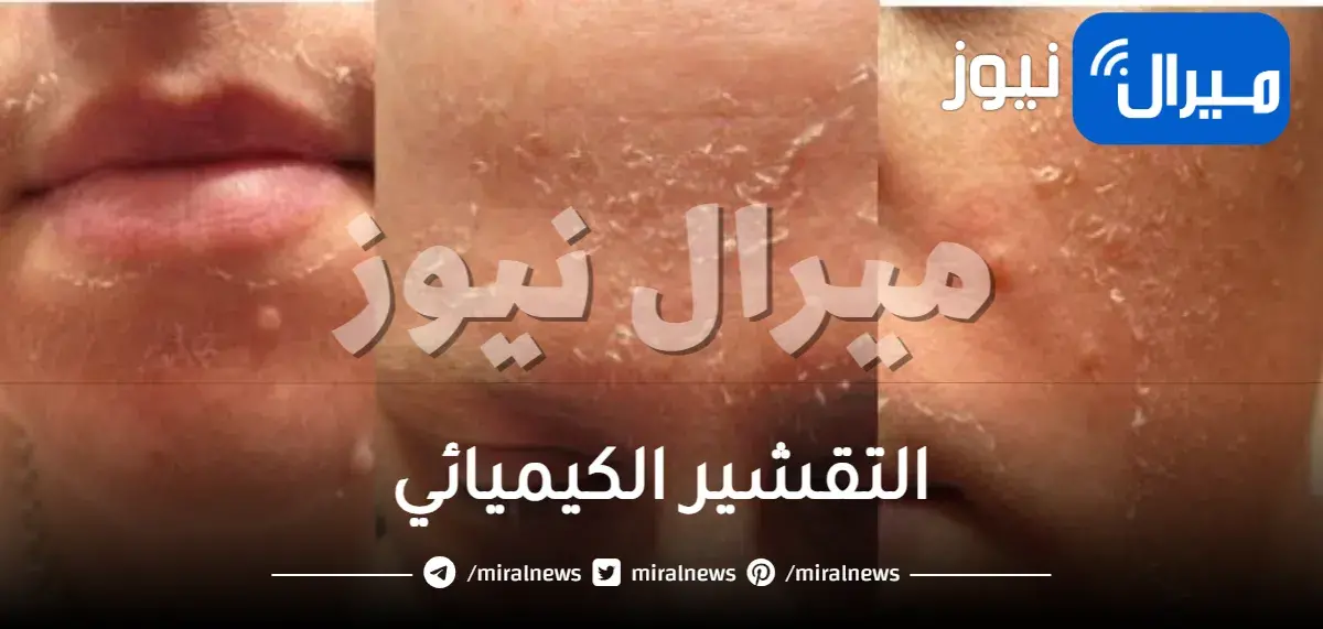 ما هو التقشير الكيميائي وما هي استخداماته وكم مدته