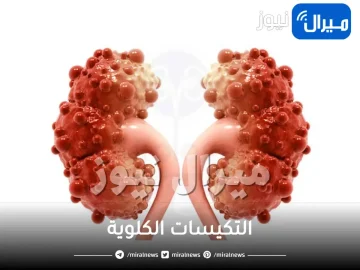 التكيسات الكلوية اعراضها واسبابها وكيفية علاجها