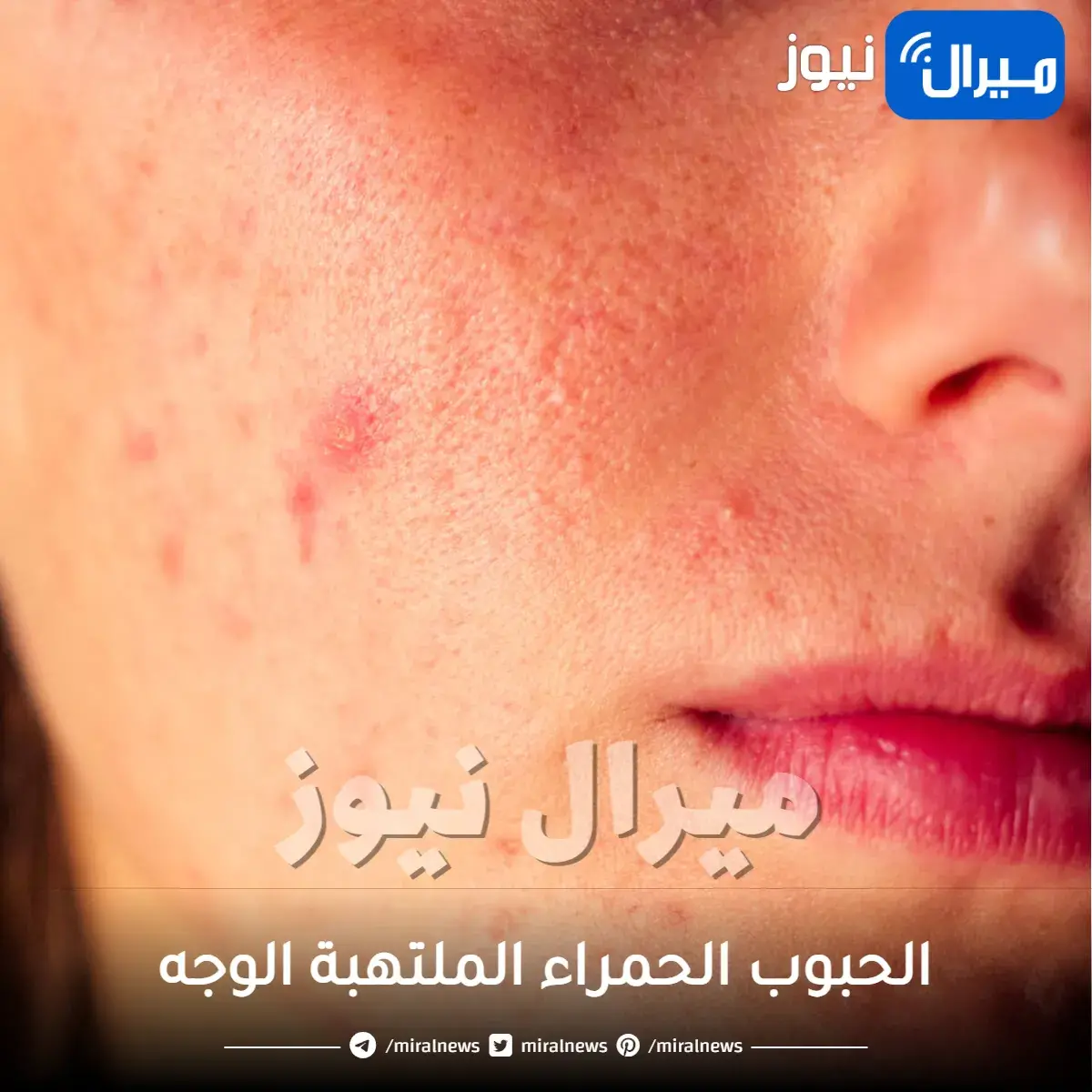 خلطات علاج الحبوب الحمراء الملتهبة الوجه بسرعة