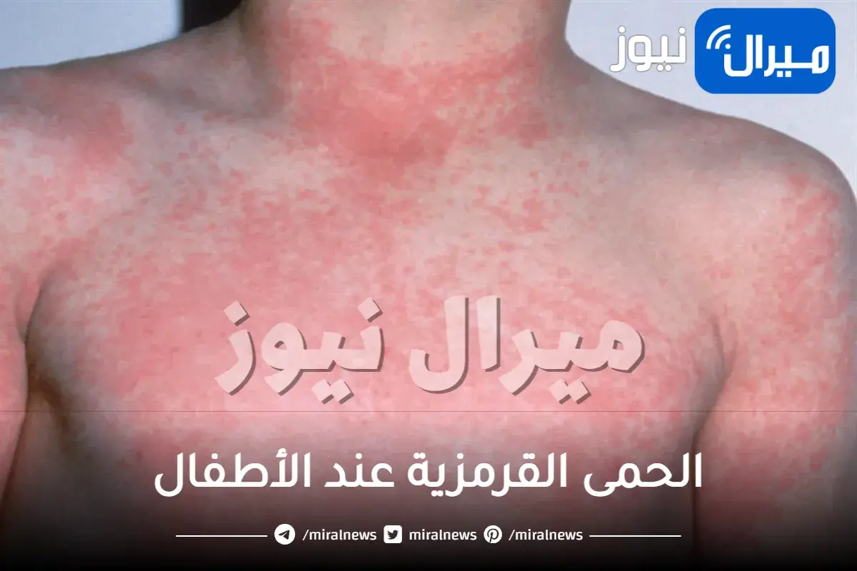 الحمى القرمزية عند الأطفال اعراضها واسبابها وطرق علاجها