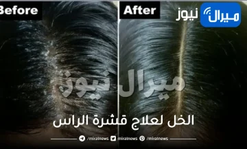 علاج قشرة الراس بالخل