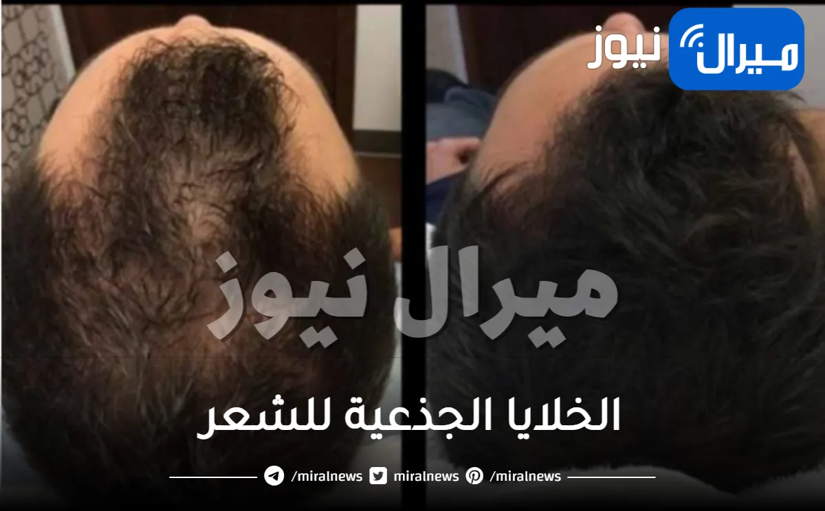 الخلايا الجذعية للشعر