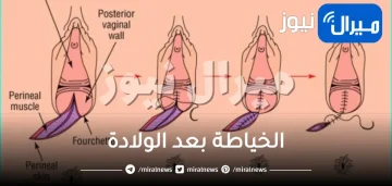 الخياطة بعد الولادة وكيفية العناية بالجرح