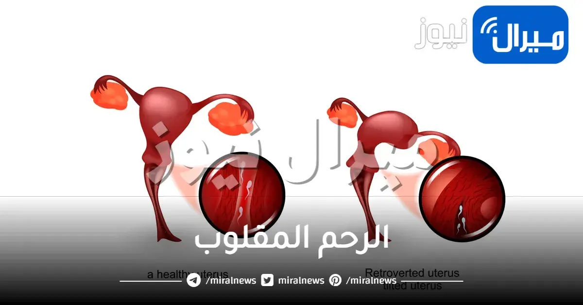 الرحم المقلوب