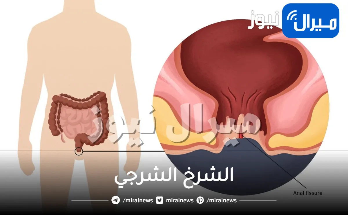 الشرخ الشرجي