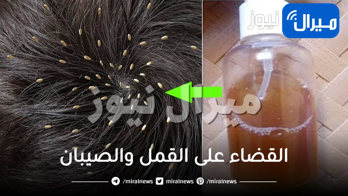 10 طرق طبيعية لعلاج القمل نهائيا
