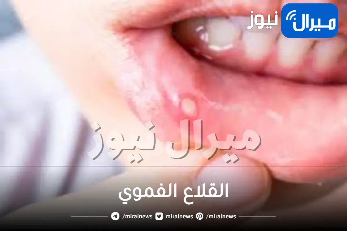 القلاع الفموي