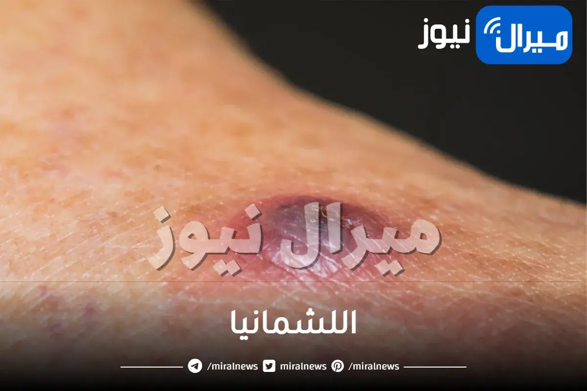 اللشمانيا